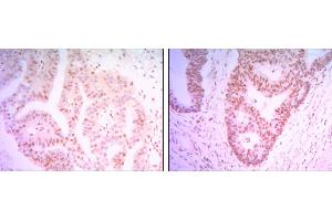 Immunohistochemical analysis of paraffin-embedded colon cancer tissues (left) and ovary cancer tissues (right) using THAP11 mouse mAb with DAB staining. (THAP11 抗体)