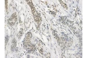 ABIN6257411 and ABIN6274478 at 1/100 staining human breast carcinoma by IHC-P.