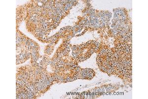 Immunohistochemistry of Human lung cancer using YARS2 Polyclonal Antibody at dilution of 1:30 (YARS2 抗体)