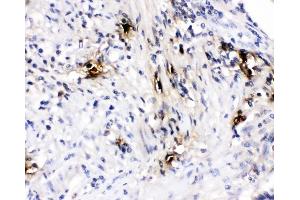 IHC analysis of Mast Cell Tryptase using anti-Mast Cell Tryptase antibody (ABIN4886754). (TPSAB1 抗体  (AA 65-275))