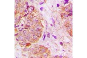 Immunohistochemical analysis of GSPT1 staining in human breast cancer formalin fixed paraffin embedded tissue section. (GSPT1 抗体)
