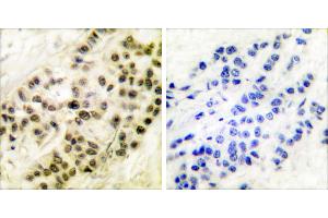 Peptide - +Immunohistochemical analysis of paraffin-embedded human breast carcinoma tissue using Cyclin B1 (Ab-126) antibody (#BOO68). (Cyclin B1 抗体  (Ser126))