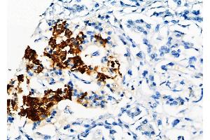 ABIN6261692 and ABIN6277568 at 1/100 staining Human pancreatic cancer and adjacent nomal tissues by IHC-P.