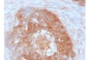 Formalin-fixed, paraffin-embedded human ovarian carcinoma stained with Fascin antibody (FSCN1/417) (Fascin 抗体)