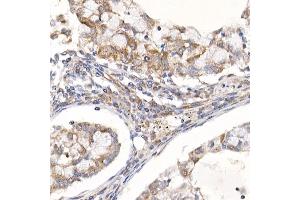 Immunohistochemistry of paraffin-embedded human lung cancer using Sterol carrier protein 2 Rabbit mAb (ABIN7270597) at dilution of 1:100 (40x lens). (SCP2 抗体)