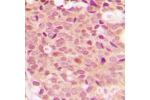 Immunohistochemical analysis of Histone Deacetylase 5 (pS498) staining in human breast cancer formalin fixed paraffin embedded tissue section. (HDAC5 抗体  (pSer498))