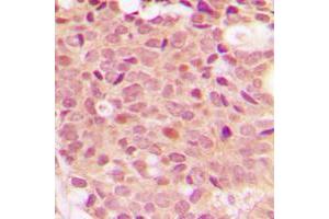 Immunohistochemical analysis of Histone Deacetylase 5 (pS498) staining in human breast cancer formalin fixed paraffin embedded tissue section.