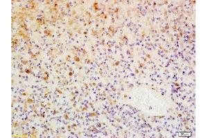 Formalin-fixed and paraffin embedded human glioma tissue labeled with Anti-WIG-1/PAG608 Polyclonal Antibody, Unconjugated  at 1:200, followed by conjugation to the secondary antibody and DAB staining (ZMAT3 抗体  (AA 201-288))