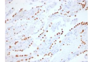 Formalin-fixed, paraffin-embedded human Lung Adenocarcinoma stained with TTF-1 Rabbit Recombinant Monoclonal Antibody (NX2. (Recombinant NKX2-1 抗体)