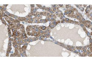 ABIN6269118 at 1/100 staining Human liver cancer tissue by IHC-P. (IGF1R 抗体  (C-Term))
