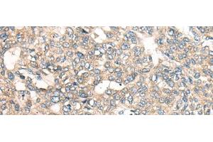 Immunohistochemistry of paraffin-embedded Human liver cancer tissue using LRP1B Polyclonal Antibody at dilution of 1:50(x200) (LRP1B 抗体)