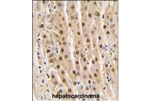 Formalin-fixed and paraffin-embedded human hepatocarcinoma tissue reacted with GDH antibody (N-term), which was peroxidase-conjugated to the secondary antibody, followed by DAB staining. (GAPDH 抗体  (N-Term))