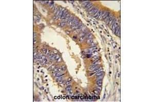 DHX58 Antibody (N-term) (ABIN651621 and ABIN2840330) immunohistochemistry analysis in formalin fixed and paraffin embedded human colon carcinoma followed by peroxidase conjugation of the secondary antibody and DAB staining. (DHX58 抗体  (N-Term))