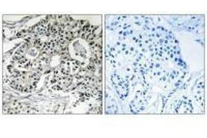 Immunohistochemistry analysis of paraffin-embedded human breast carcinoma tissue using PXMP2 antibody. (PXMP2 抗体)