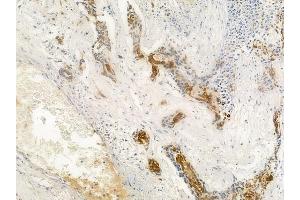 ABIN6262776 and ABIN6266570 at 1/100 staining human breast carcinoma by IHC-P. (KRT17 抗体  (C-Term))