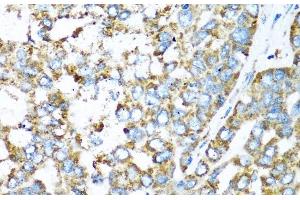 Immunohistochemistry of paraffin-embedded Human liver cancer using COX6A1 Polyclonal Antibody at dilution of 1:100 (40x lens). (COX6A1 抗体)