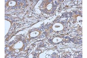 IHC-P Image Immunohistochemical analysis of paraffin-embedded human gastric cancer, using IL2, antibody at 1:500 dilution. (IL-2 抗体)