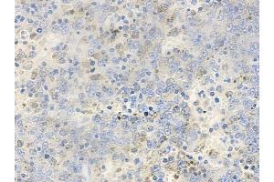 ABIN6256653 and ABIN6267393 at 1/100 staining human melanoma by IHC-P. (VAV1 抗体  (pTyr174))