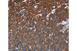 Immunohistochemistry of Human cervical cancer using FCGR3A Polyclonal Antibody at dilution of 1:40 (FCGR3A 抗体)