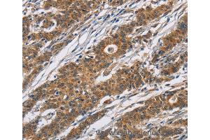 Immunohistochemistry of Human thyroid cancer using CYP21A2 Polyclonal Antibody at dilution of 1:60 (CYP21A2 抗体)