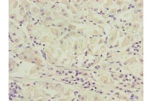 Immunohistochemistry of paraffin-embedded human gastric cancer using ABIN7170271 at dilution of 1:100 (GPR172B 抗体  (AA 212-279))