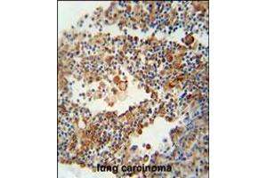 OR9Q1 antibody immunohistochemistry analysis in formalin fixed and paraffin embedded human lung carcinoma followed by peroxidase conjugation of the secondary antibody and DAB staining. (OR9Q1 抗体  (C-Term))
