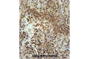 ZNF667 Antibody (Center) immunohistochemistry analysis in formalin fixed and paraffin embedded human lung carcinoma followed by peroxidase conjugation of the secondary antibody and DAB staining. (ZNF667 抗体  (Middle Region))