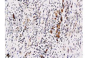 Formalin-fixed and paraffin embedded human colon carcinoma with Anti-Maspin Polyclonal Antibody, Unconjugated (ABIN728233) at 1:200, followed by conjugation to the secondary antibody and DAB staining (SERPINB5 抗体  (AA 301-375))