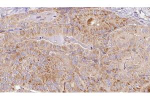 ABIN6267101 at 1/100 staining Human thyroid cancer tissue by IHC-P. (CAMKII gamma 抗体  (pTyr231))