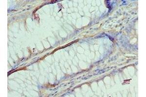 Immunohistochemistry of paraffin-embedded human colon cancer using ABIN7144363 at dilution of 1:100