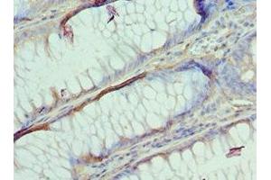 Immunohistochemistry of paraffin-embedded human colon cancer using ABIN7144363 at dilution of 1:100 (AP2B1 抗体  (AA 738-937))
