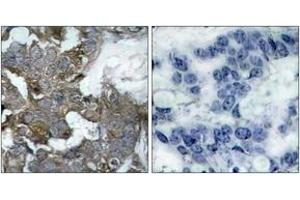 Immunohistochemistry analysis of paraffin-embedded human breast carcinoma tissue, using IkappaB-alpha (Ab-32/36) Antibody. (NFKBIA 抗体  (AA 15-64))