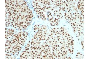 Formalin-fixed, paraffin-embedded human Melanoma stained with SOX10 Mouse Monoclonal Antibody (SOX10/991).