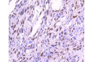 Paraformaldehyde-fixed, paraffin embedded human breast carcinoma, Antigen retrieval by boiling in sodium citrate buffer (pH6) for 15min, Block endogenous peroxidase by 3% hydrogen peroxide for 30 minutes, Blocking buffer (normal serum) at 37°C for 20min, Antibody incubation with PKC alpha(T638) (4B3) Monoclonal Antibody  at 1:50 overnight at 4°C, followed by a conjugated secondary and DAB staining. (PKC alpha 抗体  (pThr638))