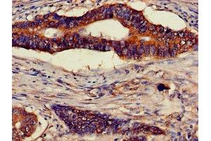 Immunohistochemistry of paraffin-embedded human colon cancer using ABIN7144852 at dilution of 1:100 (ATP5F1D 抗体  (AA 32-158))