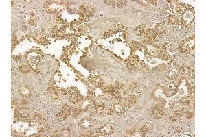 ALS2CR1 Mouse Monoclonal Antibody at 1/100 staining human ovarian cancer by IHC-P. (NIF3L1 抗体)