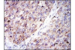 Immunohistochemical analysis of paraffin-embedded kidney cancer tissues using G6PD mouse mAb with DAB staining. (Glucose-6-Phosphate Dehydrogenase 抗体)