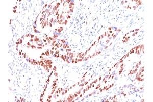Formalin-fixed, paraffin-embedded human Colon Carcinoma stained with p57 Mouse Monoclonal Antibody (KIP2/880). (CDKN1C 抗体)