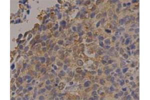 Immunohistochemical staining of human lung cancer with PGK1 monoclonal antibody, clone 14  at 1:100 dilution. (PGK1 抗体)