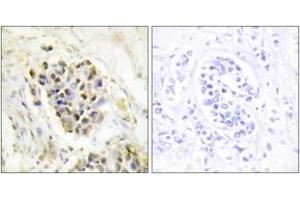 Immunohistochemistry analysis of paraffin-embedded human breast carcinoma tissue, using MED1 Antibody. (MED1 抗体  (AA 641-690))