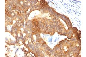Formalin-fixed, paraffin-embedded Colon Carcinoma stained with Cytokeratin 8 Mouse Monoclonal Antibody (B22. (KRT8 抗体)