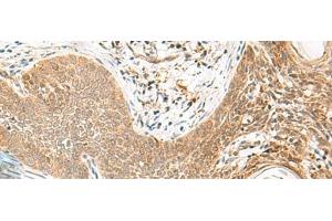 Immunohistochemistry of paraffin-embedded Human esophagus cancer tissue using ORC4 Polyclonal Antibody at dilution of 1:80(x200) (ORC4 抗体)