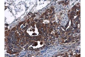 IHC-P Image DNase I antibody [N1C3] detects DNase I protein at cytoplasm in human cervical carcinoma by immunohistochemical analysis. (DNASE1 抗体)