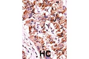 Formalin-fixed and paraffin-embedded human cancer tissue reacted with the primary antibody, which was peroxidase-conjugated to the secondary antibody, followed by AEC staining. (CHEK1 抗体  (pSer317))