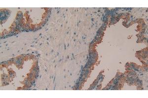 Detection of TIMP1 in Human Prostate Tissue using Polyclonal Antibody to Tissue Inhibitors Of Metalloproteinase 1 (TIMP1) (TIMP1 抗体  (AA 25-207))