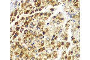 Immunohistochemistry of paraffin-embedded Human liver cancer using SND1 Polyclonal Antibody at dilution of 1:100 (40x lens). (SND1 抗体)