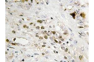 Immunohistochemistry analyzes of FoxC1/2 antibody in paraffin-embedded human prostate carcinoma tissue. (FOXC1 抗体)
