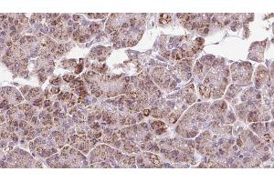 ABIN6273250 at 1/100 staining Human pancreas cancer tissue by IHC-P. (GPD2 抗体  (N-Term))