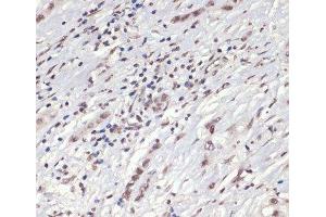 Immunohistochemistry of paraffin-embedded Human liver cancer using Phospho-Jak2(Y1007/1008) Polyclonal Antibody at dilution of 1:200 (40x lens). (JAK2 抗体  (pTyr1007, pTyr1008))