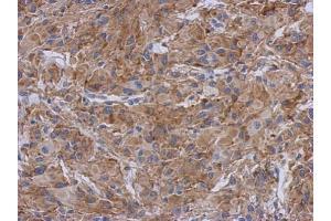 IHC-P Image Immunohistochemical analysis of paraffin-embedded U373 xenograft, using Radixin, antibody at 1:500 dilution. (Radixin 抗体)